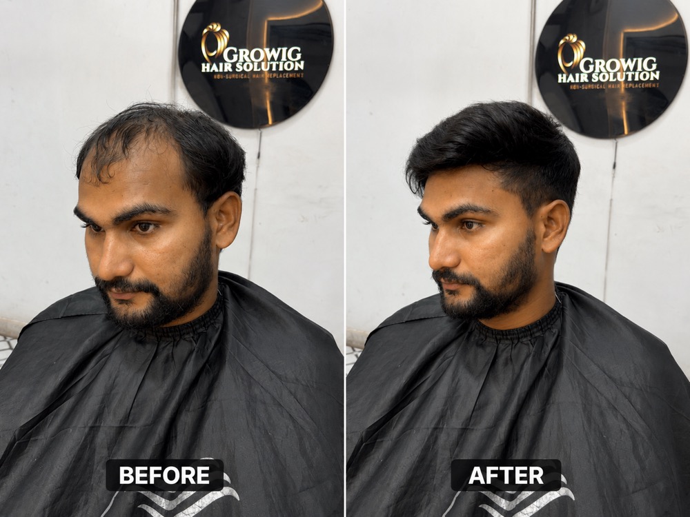 Classic Hair Restoration - Before and After